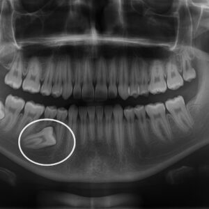 Tratamiento de un diente retenido