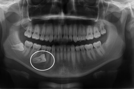 Tratamiento de un diente retenido