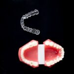 Férulas dentales para el dolor orofacial: cuándo son recomendables
